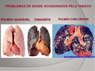 PROBLEMAS DE SAÚDE OCASIONADOS PELO TABACO



PULMÃO SAUDÁVEL   TABAGISTA   PULMÃO COM CÂNCER
 