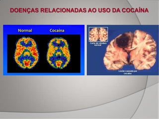 DOENÇAS RELACIONADAS AO USO DA COCAÍNA
 