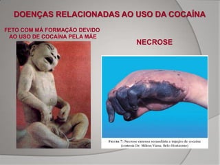 DOENÇAS RELACIONADAS AO USO DA COCAÍNA
FETO COM MÁ FORMAÇÃO DEVIDO
 AO USO DE COCAÍNA PELA MÃE
                              NECROSE
 
