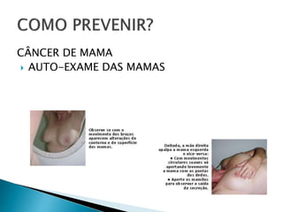 CÂNCER DE MAMA
 AUTO-EXAME DAS MAMAS
 