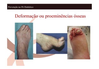 Prevenção no Pé Diabético



      Deformação ou proeminências ósseas
 