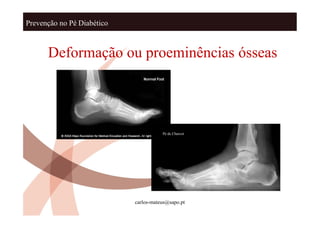 Prevenção no Pé Diabético



      Deformação ou proeminências ósseas




                                       Pé de Charcot




                            carlos-mateus@sapo.pt
 