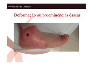 Prevenção no Pé Diabético



      Deformação ou proeminências ósseas
 