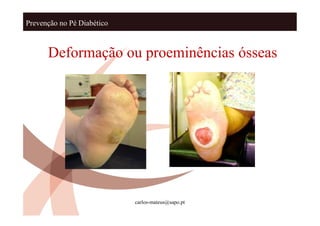 Prevenção no Pé Diabético



      Deformação ou proeminências ósseas




                            carlos-mateus@sapo.pt
 