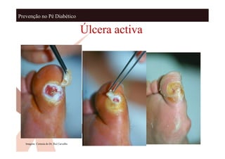 Prevenção no Pé Diabético

                                           Úlcera activa




   Imagens: Cortesia do Dr. Rui Carvalho
 