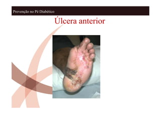 Prevenção no Pé Diabético

                            Úlcera anterior
 