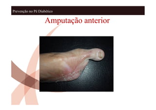 Prevenção no Pé Diabético

                    Amputação anterior
 