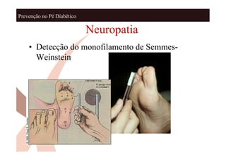 Prevenção no Pé Diabético

                            Neuropatia
    • Detecção do monofilamento de Semmes-
      Weinstein
 