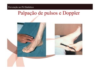 Prevenção no Pé Diabético

         Palpação de pulsos e Doppler
 