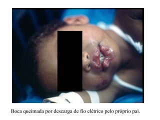 Boca queimada por descarga de fio elétrico pelo próprio pai.
 