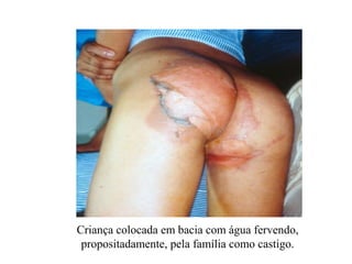 Criança colocada em bacia com água fervendo,
 propositadamente, pela família como castigo.
 