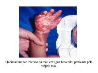 Queimadura por imersão da mão em água fervendo, praticada pela
                        própria mãe.
 
