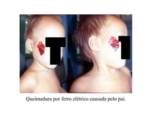 Queimadura por ferro elétrico causada pelo pai.
 