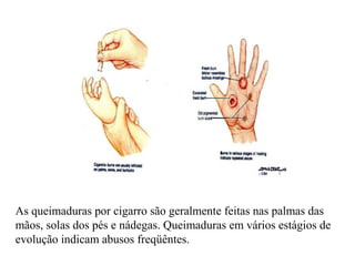 As queimaduras por cigarro são geralmente feitas nas palmas das
mãos, solas dos pés e nádegas. Queimaduras em vários estágios de
evolução indicam abusos freqüêntes.
 
