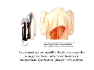 As queimaduras por utensílios domésticos aquecidos
    como garfos, facas, colheres são freqüentes.
 Na ilustração, queimadura típica por ferro elétrico.
 