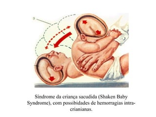 Síndrome da criança sacudida (Shaken Baby
Syndrome), com possibidades de hemorragias intra-
                   crianianas.
 