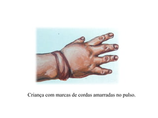Criança com marcas de cordas amarradas no pulso.
 