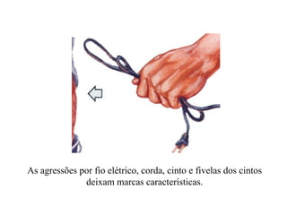 As agressões por fio elétrico, corda, cinto e fivelas dos cintos
              deixam marcas características.
 