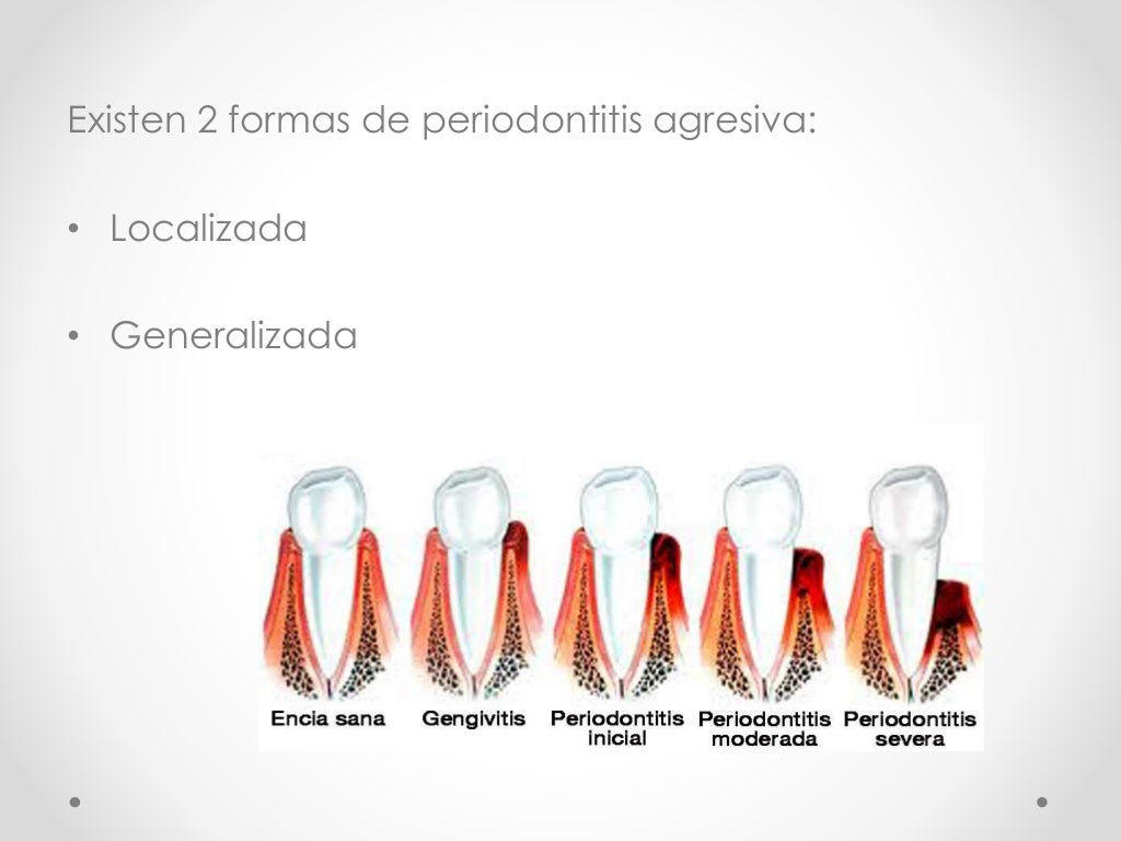 clasificacion de las enfermedades periodontales