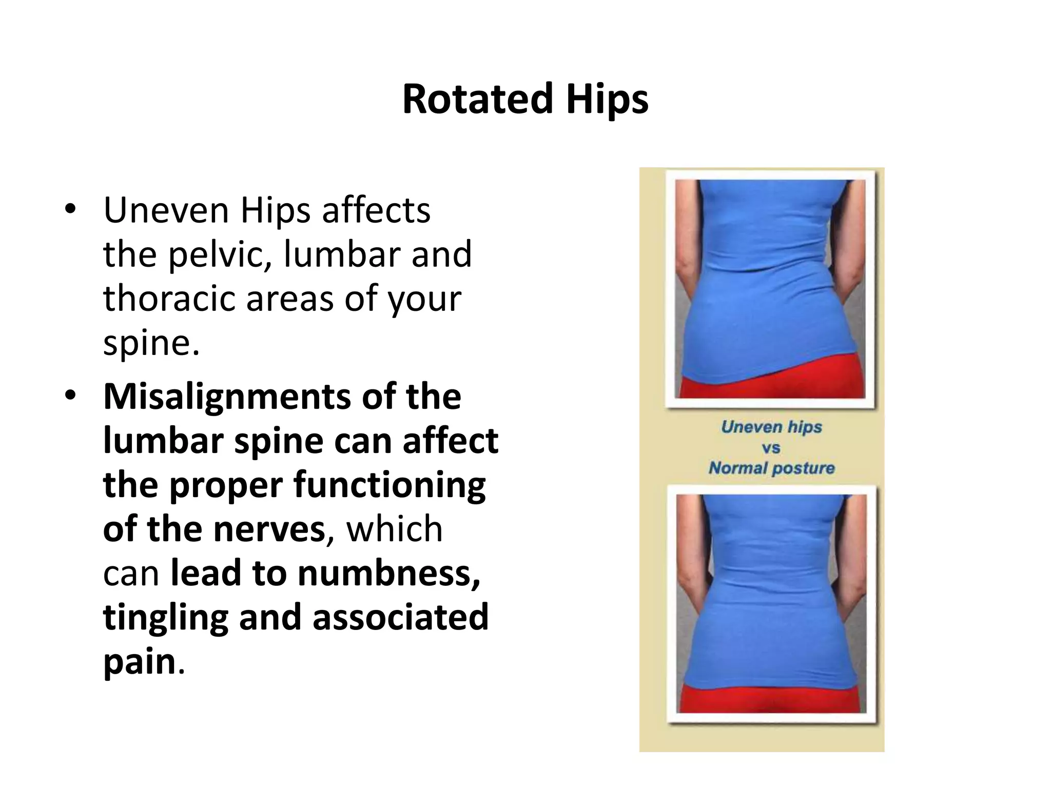 Rotated Hips
• Uneven Hips affects
the pelvic, lumbar and
thoracic areas of your
spine.
• Misalignments of the
lumbar spine can affect
the proper functioning
of the nerves, which
can lead to numbness,
tingling and associated
pain.
 