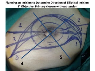 Orr Incision Preventing Surgical Complications of Modified Radical Mastectomy | PPT