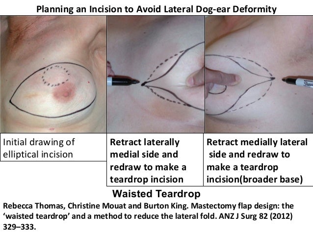 Dog Ears After Mastectomy Photos Dog Ears After Mastectomy Photos