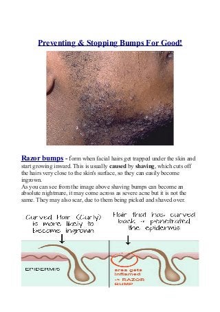 Preventing & Stopping Bumps For Good!
Razor bumps - form when facial hairs get trapped under the skin and
start growing in...