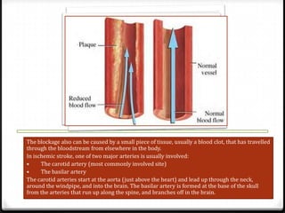 The blockage also can be caused by a small piece of tissue, usually a blood clot, that has travelled
through the bloodstream from elsewhere in the body.
In ischemic stroke, one of two major arteries is usually involved:
•
The carotid artery (most commonly involved site)
•
The basilar artery
The carotid arteries start at the aorta (just above the heart) and lead up through the neck,
around the windpipe, and into the brain. The basilar artery is formed at the base of the skull
from the arteries that run up along the spine, and branches off in the brain.

 
