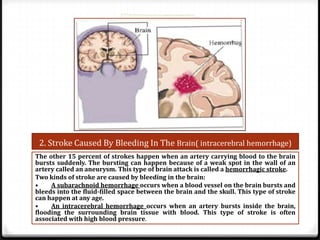 2. Stroke Caused By Bleeding In The Brain( intracerebral hemorrhage)
The other 15 percent of strokes happen when an artery carrying blood to the brain
bursts suddenly. The bursting can happen because of a weak spot in the wall of an
artery called an aneurysm. This type of brain attack is called a hemorrhagic stroke.
Two kinds of stroke are caused by bleeding in the brain:
•
A subarachnoid hemorrhage occurs when a blood vessel on the brain bursts and
bleeds into the fluid-filled space between the brain and the skull. This type of stroke
can happen at any age.
•
An intracerebral hemorrhage occurs when an artery bursts inside the brain,
flooding the surrounding brain tissue with blood. This type of stroke is often
associated with high blood pressure.

 