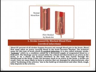 1. Stroke Caused By Blocked Blood Flow
(cerebral infarction)
About 85 percent of all strokes happen because not enough blood gets to the brain. Blood
flow stops when an artery carrying blood to the brain becomes blocked. The technical
name for this type of brain attack is cerebral infarction. It is also called ischemic stroke.
"Ischemic" refers to a condition caused by a decreased supply of oxygenated blood to a
body part .The blockage can be caused either by a blood clot that forms in an artery in the
brain, or by a blood clot formed elsewhere in the body that travels through the
bloodstream to the brain. If this clot becomes stuck in an artery in the brain, a stroke can
result. Clots are more likely to form in arteries that are damaged by atherosclerosis, also
called "hardening of the arteries," due to the build up of cholesterol and other thick, rough,
fatty deposits in the arteries.

 