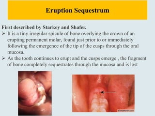 Eruption Sequestrum
First described by Starkey and Shafer.
 It is a tiny irregular spicule of bone overlying the crown of an
erupting permanent molar, found just prior to or immediately
following the emergence of the tip of the cusps through the oral
mucosa.
 As the tooth continues to erupt and the cusps emerge , the fragment
of bone completely sequestrates through the mucosa and is lost
 