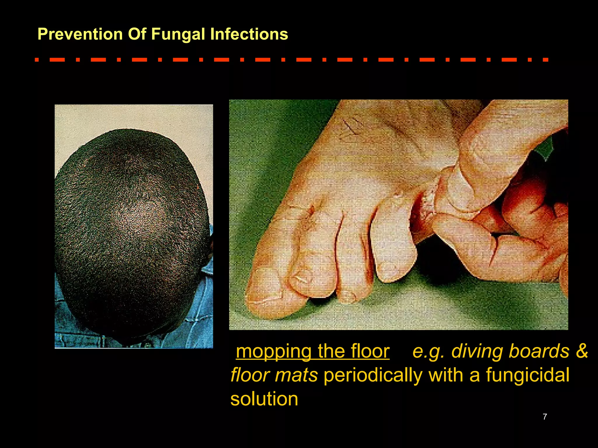 PREVENTION OF FUNGAL INFECTIONS | PPT