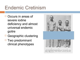 Endemic Cretinism
 Occurs in areas of
severe iodine
deficiency and almost
universal endemic
goitre
 Geographic clustering
 Two predominant
clinical phenotypes
 