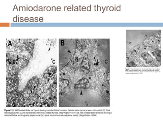 Amiodarone related thyroid
disease
 