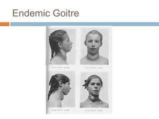 Endemic Goitre
 