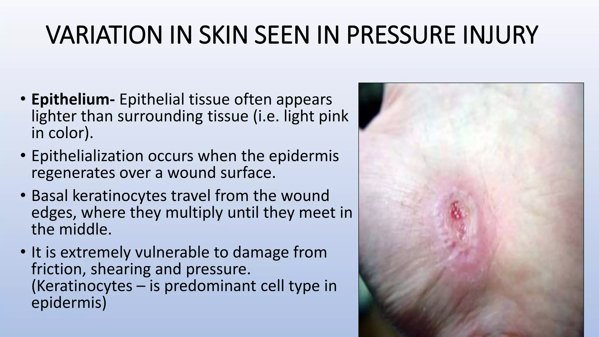 Prevention and management of pressure injury | PPTX
