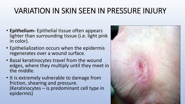 Pc Line Injury Prevention and management of pressure injury | PPTX