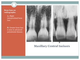 Bone loss on
radiographs.
A. A. Slight

interproximal bone
loss.

B. B. Greater bone loss

is seen in advanced
periodontal disease.

A

B

Maxillary Central Incisors

 