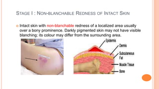 Prevention of Bed Sore Injuries in ICU patients.pptx