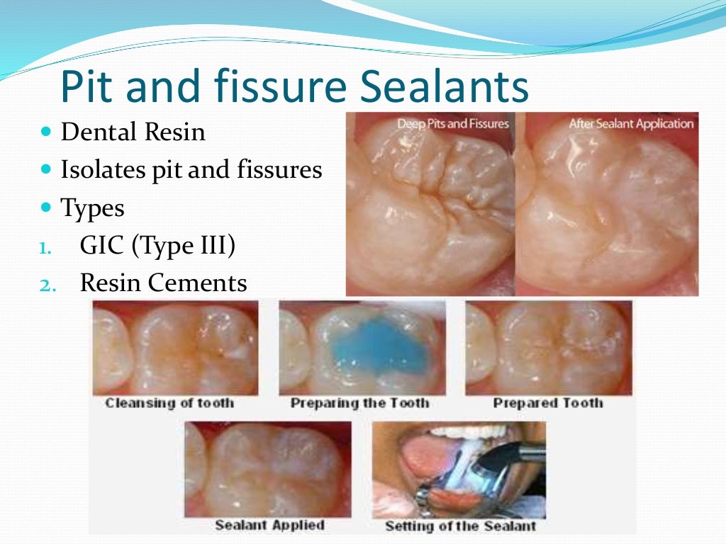 Prevention of dental caries
