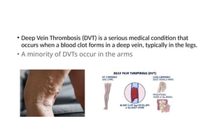 Comprehensive Guide to Prevention and Treatment of Deep Vein Thrombosis ...