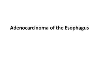 Adenocarcinoma of the Esophagus
 