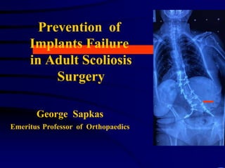 George Sapkas
Emeritus Professor of Orthopaedics
Prevention of
Implants Failure
in Adult Scoliosis
Surgery
 