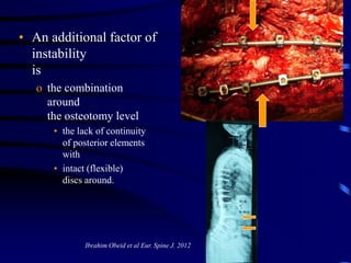 • An additional factor of
instability
is
o the combination
around
the osteotomy level
• the lack of continuity
of posterio...