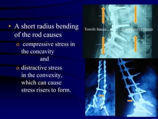 • A short radius bending
of the rod causes
o compressive stress in
the concavity
and
o distractive stress
in the convexity...