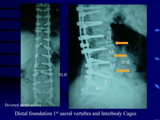 Distal foundation 1st sacral vertebra and Interbody Cages
Diverted sacral screws
TLIF
S1
L2
TLIF
L5
L4
L3
 