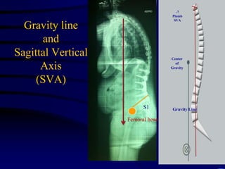 Gravity line
and
Sagittal Vertical
Axis
(SVA)
Femoral head
S1 Gravity Line
Center
of
Gravity
C7
Plumb
SVA
 
