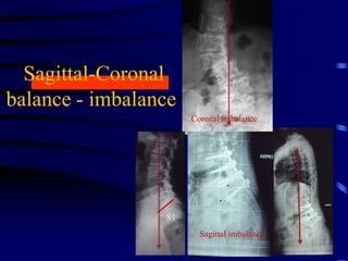 Sagittal-Coronal
balance - imbalance
S1
Coronal imbalance
Sagittal imbalance
 
