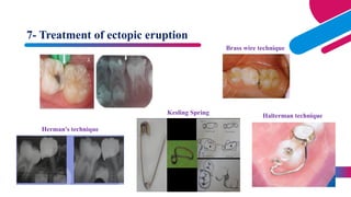 Prevention of occclusal abnormalities=.pptx