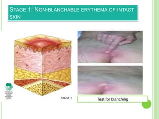 PREVENTION OF PRESSURE ULCER/BED SORE/PRESSURE SORE | PPTX